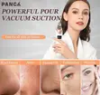 5-in-1 Blackhead Remover Machine - 4