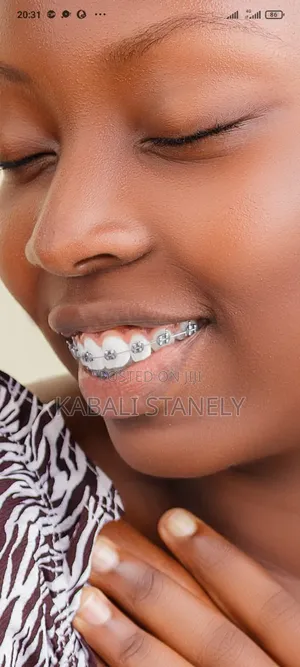 Dental Braces - Sac Dental Care