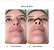 Intake Nasal Dilator / Magnetic Nasal Dilator Set - 3