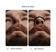 Intake Nasal Dilator / Magnetic Nasal Dilator Set - 5